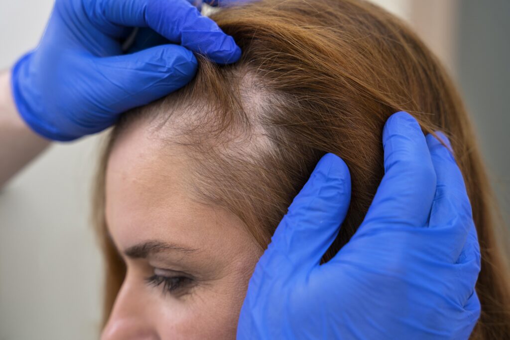 Alopecia: quando a queda de cabelo se torna um sinal de alerta
