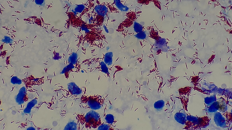 Inteligência artificial e exame de sangue combinam para diagnóstico precoce da hanseníase